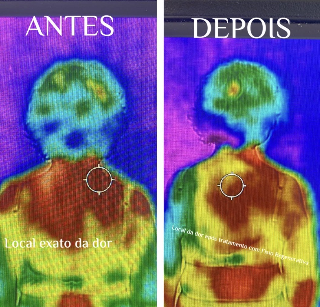 Comparativo termográfico de acompanhamento de dor na região cervical e torácica